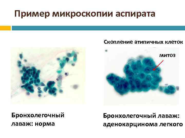 Пример микроскопии аспирата Скопление атипичных клеток митоз Бронхолегочный лаваж: норма Бронхолегочный лаваж: аденокарцинома легкого