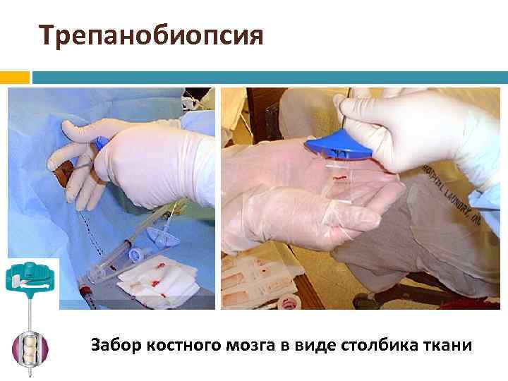 Трепанобиопсия Забор костного мозга в виде столбика ткани 37 