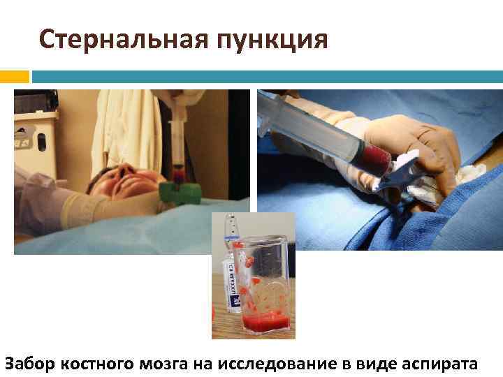 Стернальная пункция Забор костного мозга на исследование в виде аспирата 