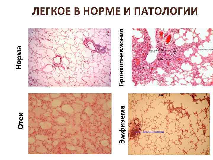 Норма Бронхопневмония Отек Эмфизема ЛЕГКОЕ В НОРМЕ И ПАТОЛОГИИ 