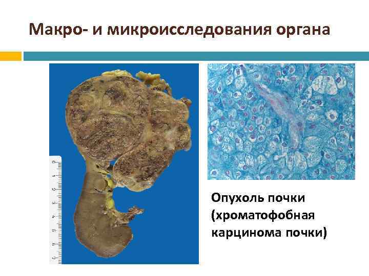 Макро- и микроисследования органа Опухоль почки (хроматофобная карцинома почки) 
