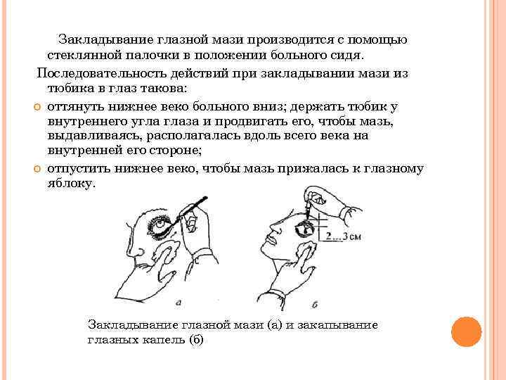Закладывание глазной мази производится с помощью стеклянной палочки в положении больного сидя. Последовательность действий