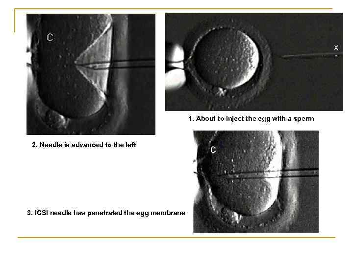 1. About to inject the egg with a sperm 2. Needle is advanced to