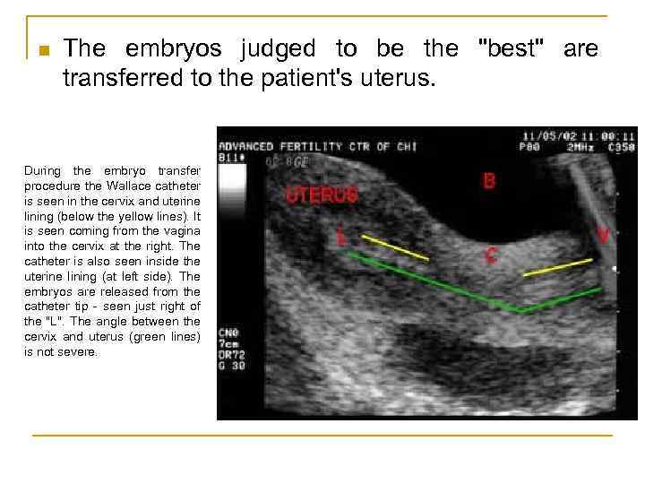 n The embryos judged to be the "best" are transferred to the patient's uterus.