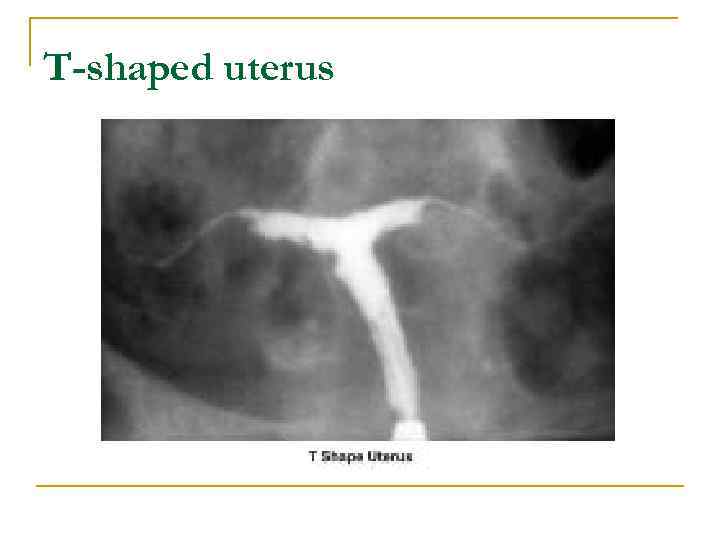 T-shaped uterus 