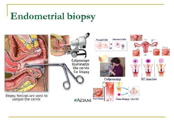 Endometrial biopsy 