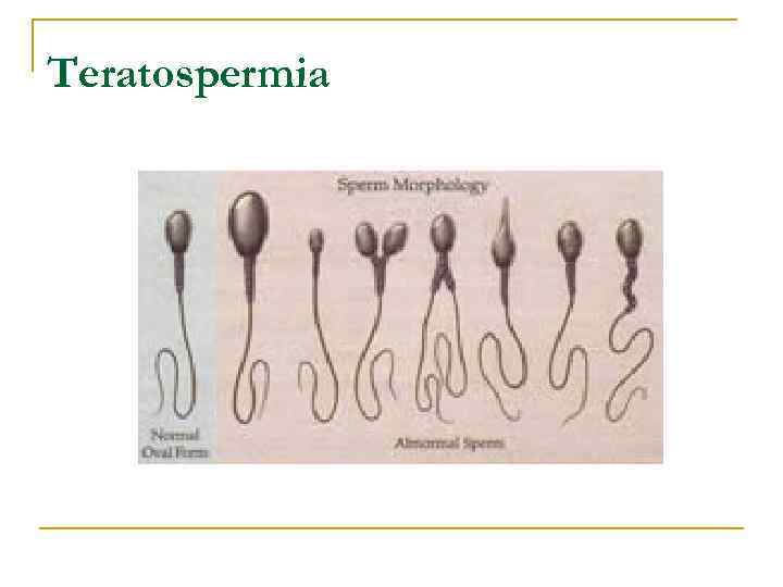 Teratospermia 
