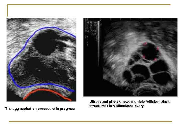 The egg aspiration procedure in progress Ultrasound photo shows multiple follicles (black structures) in