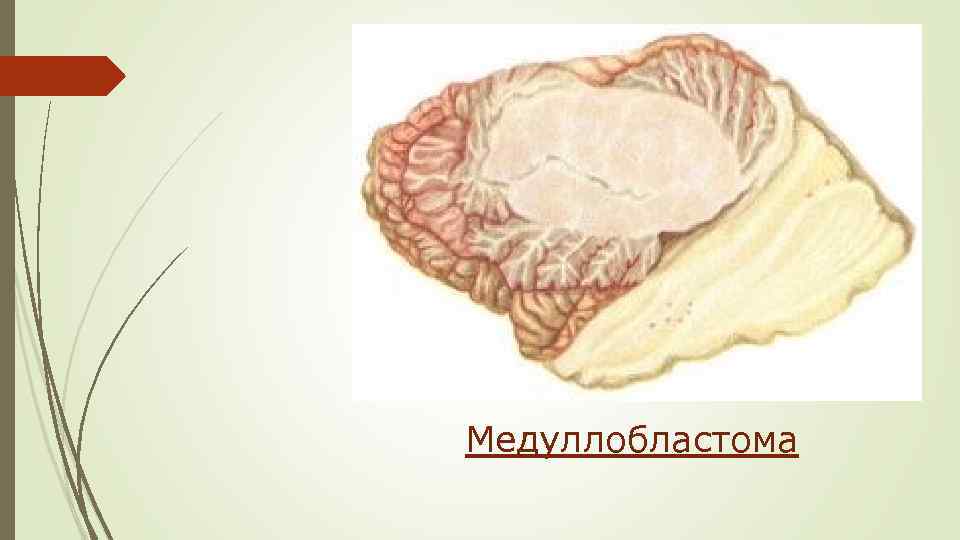 Медуллобластома 