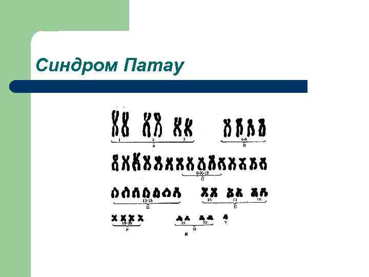 Синдром Патау 