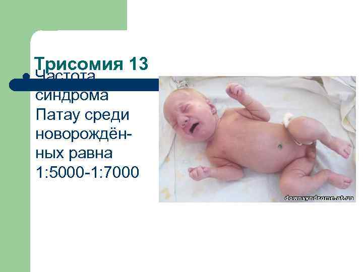 l Трисомия 13 Частота синдрома Патау среди новорождённых равна 1: 5000 -1: 7000 
