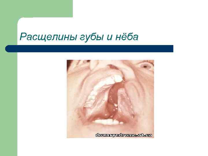 Расщелины губы и нёба 