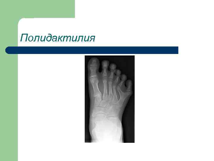 Полидактилия 