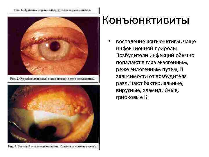 Конъюнктивиты • воспаление конъюнктивы, чаще инфекционной природы. Возбудители инфекций обычно попадают в глаз экзогенным,