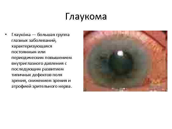 Глаукома • Глауко ма — большая группа глазных заболеваний, характеризующаяся постоянным или периодическим повышением