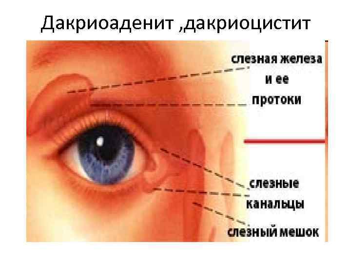 Дакриоаденит , дакриоцистит 