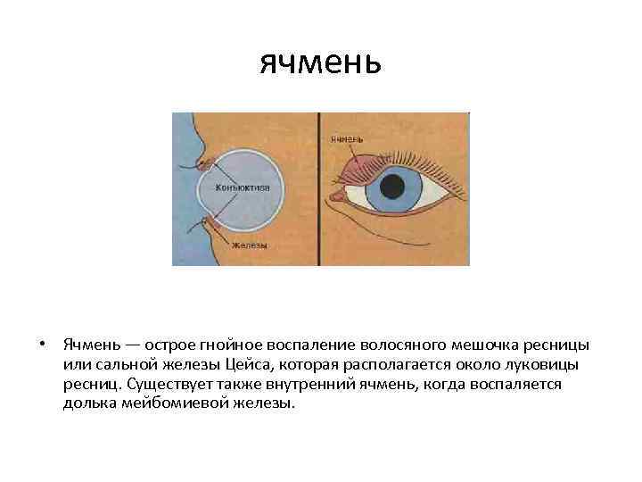 ячмень • Ячмень — острое гнойное воспаление волосяного мешочка ресницы или сальной железы Цейса,