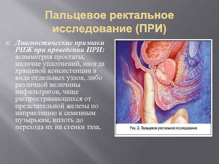 Пальцевое ректальное исследование (ПРИ) Диагностические признаки РПЖ при проведении ПРИ: асимметрия простаты, наличие уплотнений,