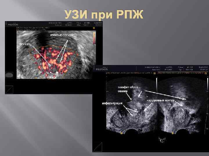 УЗИ при РПЖ 