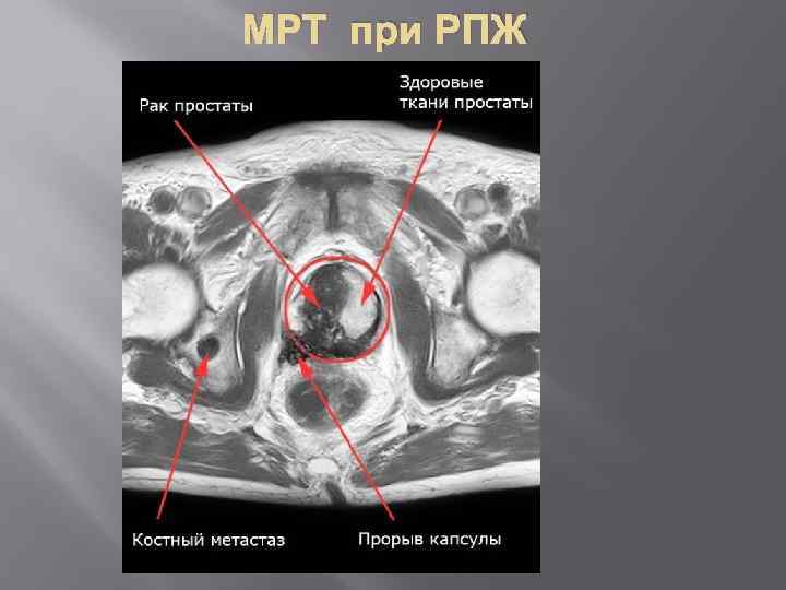 МРТ при РПЖ 