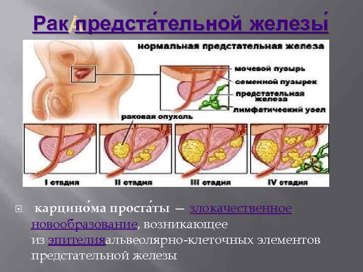 Рак предста тельной железы карцино ма проста ты — злокачественное новообразование, возникающее из эпителияальвеолярно-клеточных