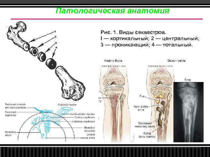 Патологическая анатомия Рис. 1. Виды секвестров. I — кортикальный; 2 — центральный; 3 —