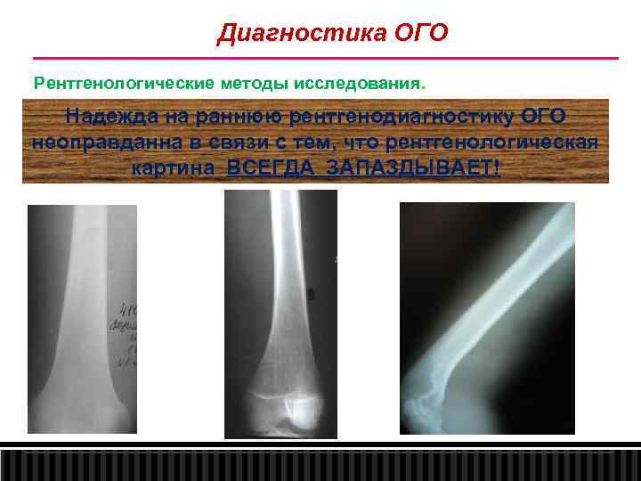 Диагностика ОГО Рентгенологические методы исследования. Надежда на раннюю рентгенодиагностику ОГО неоправданна в связи с