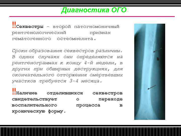 Диагностика ОГО ‼Секвестры - второй патогномоничный рентгенологический признак гематогенного остеомиелита. Сроки образования секвестров различны.