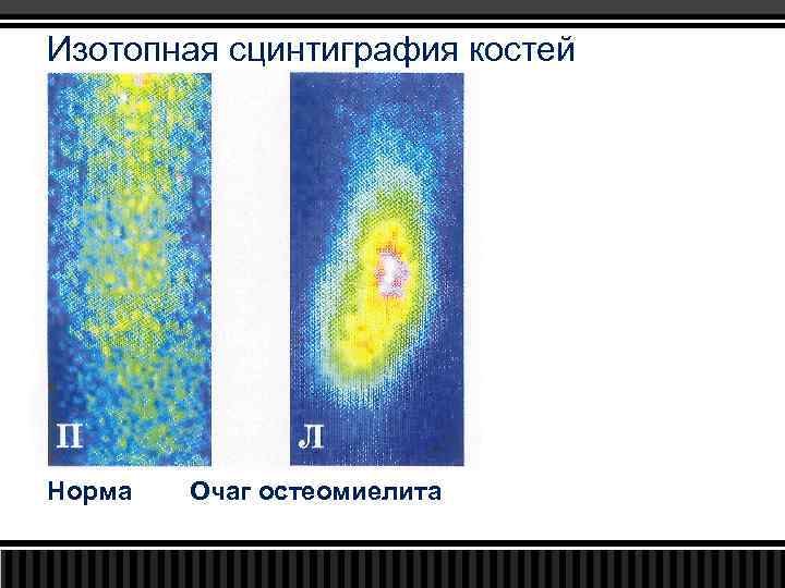 Изотопная сцинтиграфия костей Норма Очаг остеомиелита 