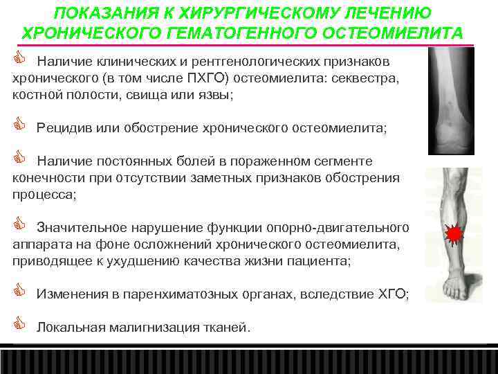 ПОКАЗАНИЯ К ХИРУРГИЧЕСКОМУ ЛЕЧЕНИЮ ХРОНИЧЕСКОГО ГЕМАТОГЕННОГО ОСТЕОМИЕЛИТА C Наличие клинических и рентгенологических признаков хронического