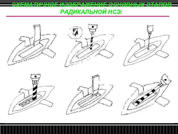 СХЕМАТИЧНОЕ ИЗОБРАЖЕНИЕ ОСНОВНЫХ ЭТАПОВ РАДИКАЛЬНОЙ НСЭ: 