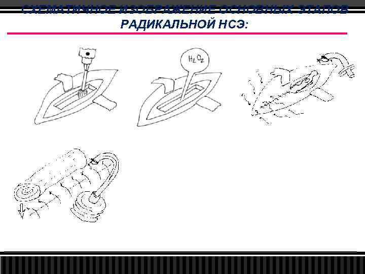 СХЕМАТИЧНОЕ ИЗОБРАЖЕНИЕ ОСНОВНЫХ ЭТАПОВ РАДИКАЛЬНОЙ НСЭ: 