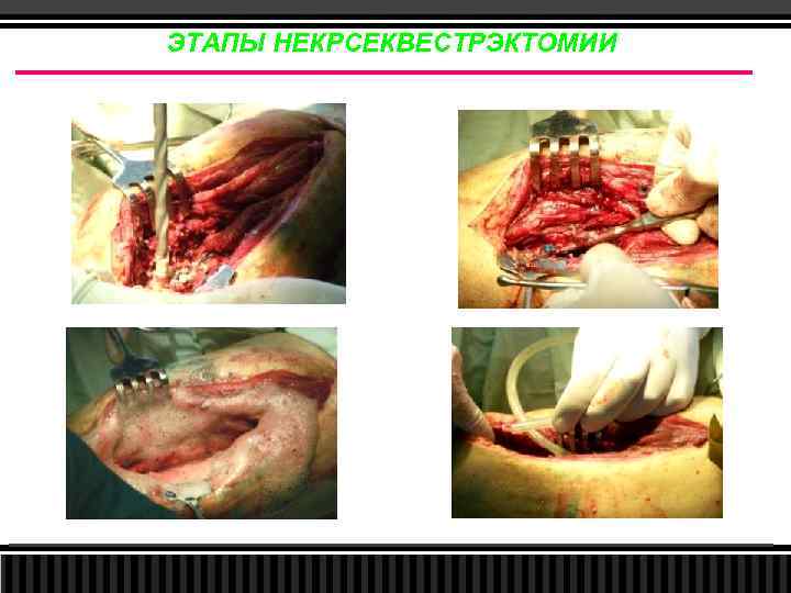 ЭТАПЫ НЕКРСЕКВЕСТРЭКТОМИИ 