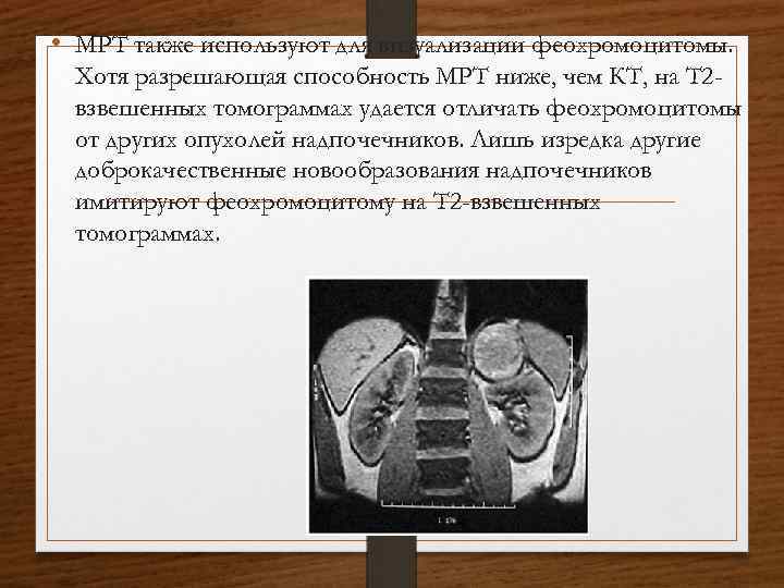  • МРТ также используют для визуализации феохромоцитомы. Хотя разрешающая способность МРТ ниже, чем