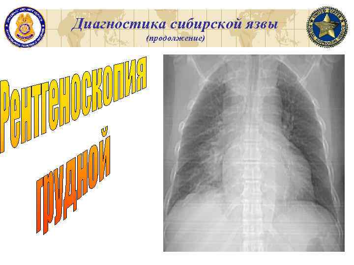 Диагностика сибирской язвы (продолжение) 