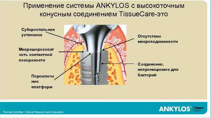 Концепция максимальной ANKYLOS с тканей (Tissue Care) протекции высокоточным Применение системы имплантатов Tissue. Care-это