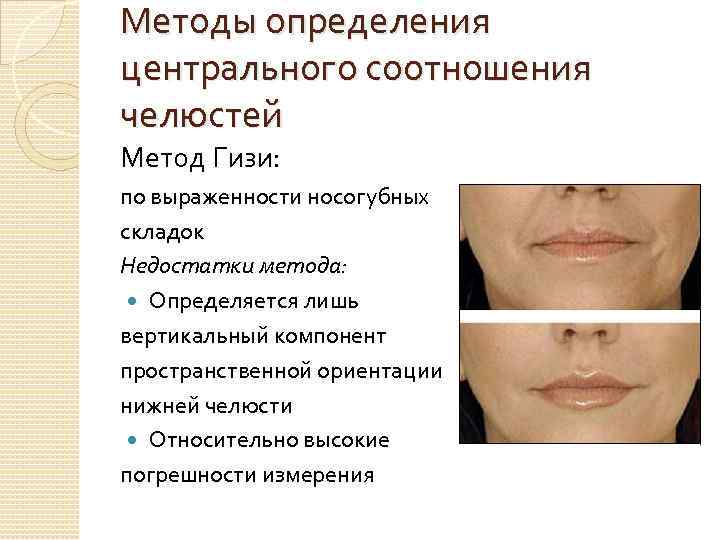 Методы определения центрального соотношения челюстей Метод Гизи: по выраженности носогубных складок Недостатки метода: Определяется