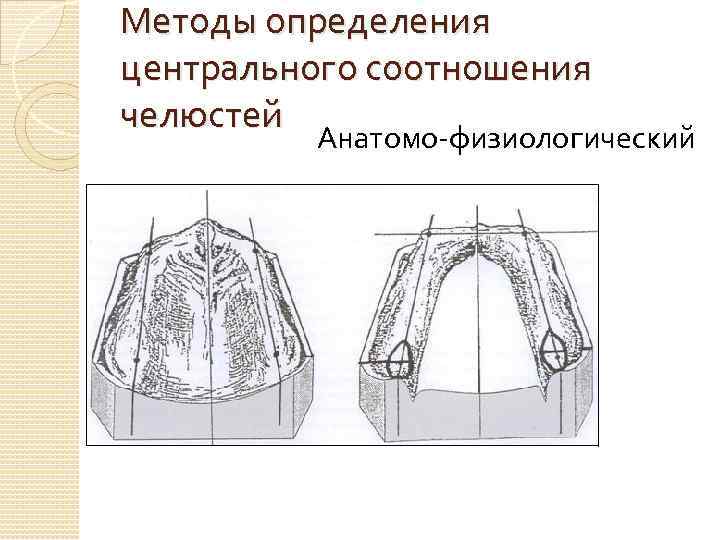 Методы определения центрального соотношения челюстей Анатомо-физиологический 
