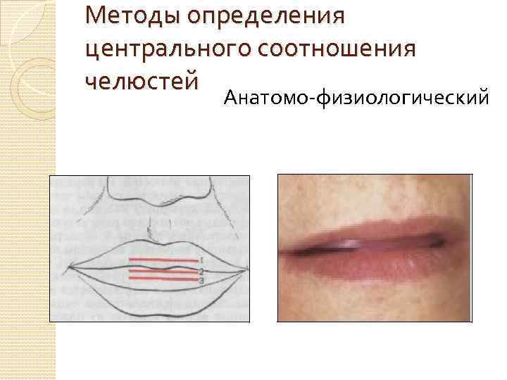Методы определения центрального соотношения челюстей Анатомо-физиологический 