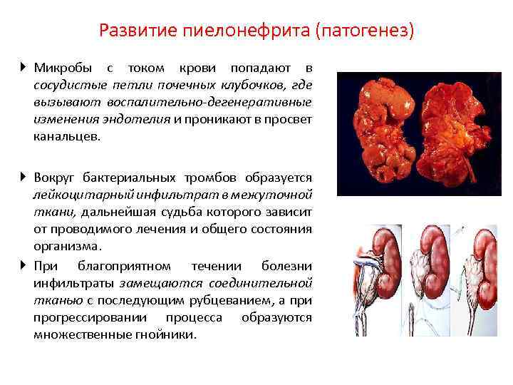 Развитие пиелонефрита (патогенез) Микробы с током крови попадают в сосудистые петли почечных клубочков, где