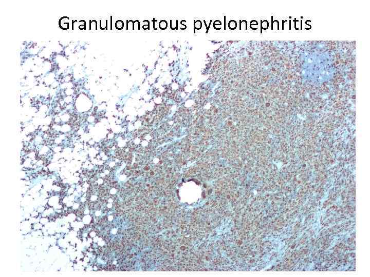 Granulomatous pyelonephritis 