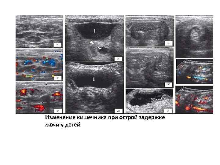 Изменения кишечника при острой задержке мочи у детей 