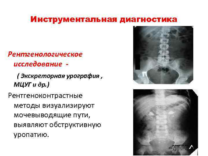 Инструментальная диагностика Рентгенологическое исследование ( Экскреторная урография , МЦУГ и др. ) Рентгеноконтрастные методы