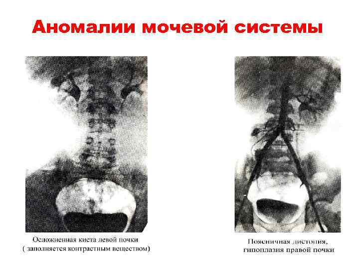 Аномалии мочевой системы 