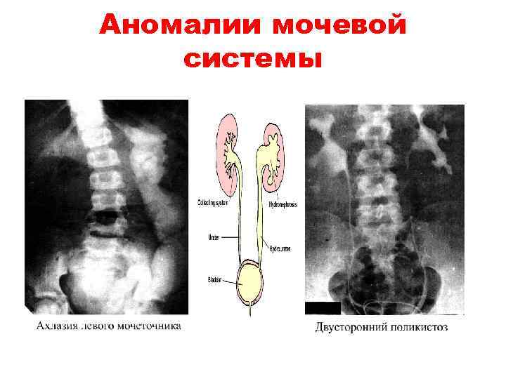 Аномалии мочевой системы 