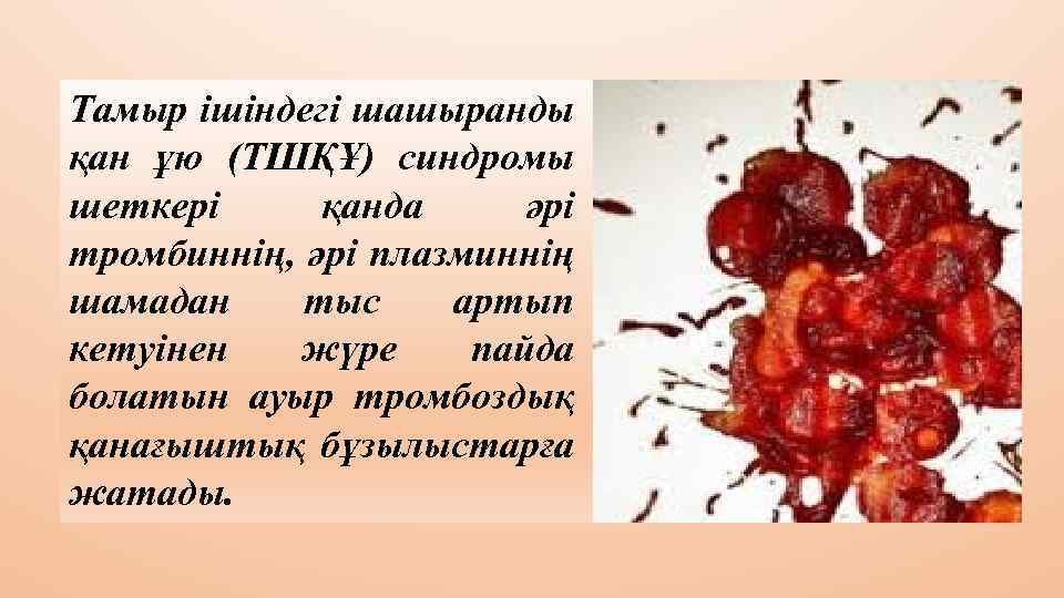 Тамыр ішіндегі шашыранды қан ұю (ТШҚҰ) синдромы шеткері қанда әрі тромбиннің, әрі плазминнің шамадан
