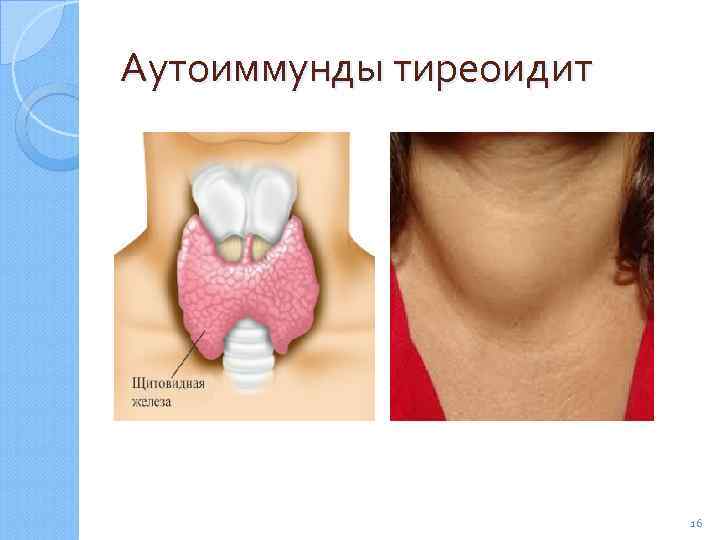 Аутоиммунды тиреоидит 16 