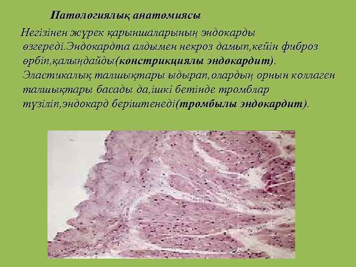 Патологиялық анатомиясы Негізінен жүрек қарыншаларының эндокарды өзгереді. Эндокардта алдымен некроз дамып, кейін фиброз өрбіп,