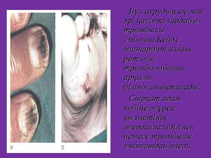 Бұл аурудың ең жиі әрі қауіпті зардабытромбылы эмболия. Кейде миокардит алғаш рет осы тромбоэмболия