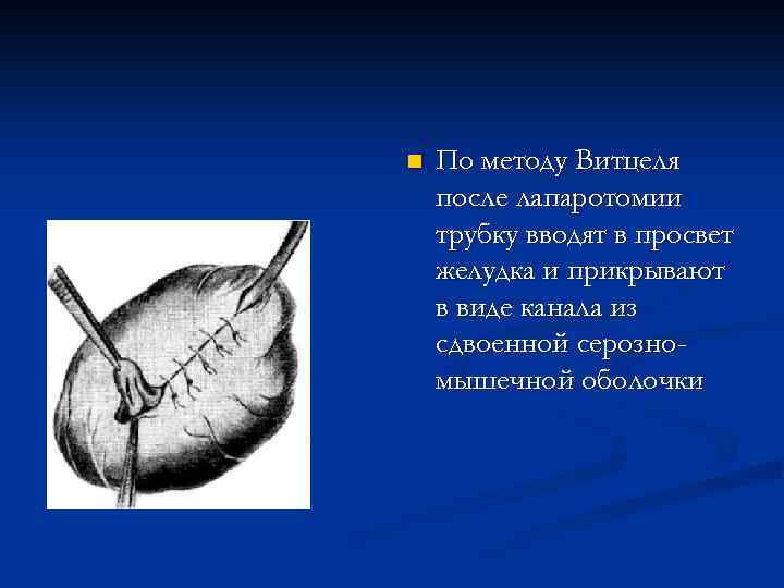 n По методу Витцеля после лапаротомии трубку вводят в просвет желудка и прикрывают в